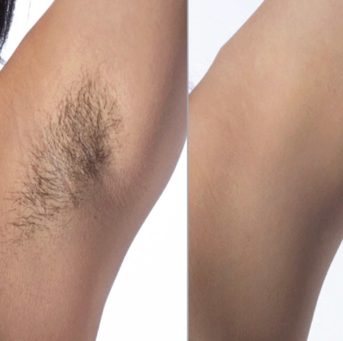 Cyperus Rotundus Oil - Permanent Hair Reduction