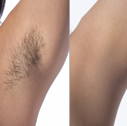 Cyperus Rotundus Oil - Permanent Hair Reduction